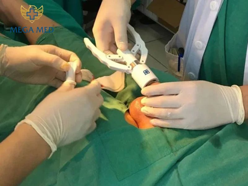 lột bao quy đầu bị sưng